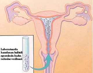 Aşılama, IUI, gebelik oluşumu, infertilite, kısırlık