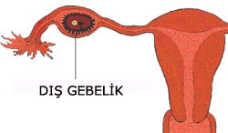 D gebelik, ektopik gebelik, ex-u