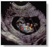 Doppler ultrasonu, bebeğin iyilik testlerindendir..