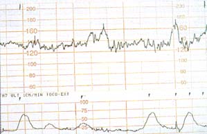 Non-stress test, bebeğin kalp atımlarının grafik kağıda aktarılması